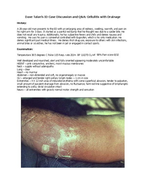 Case Study Cellulitis with Drainage